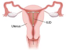 Résultat de recherche d'images pour "IUD"